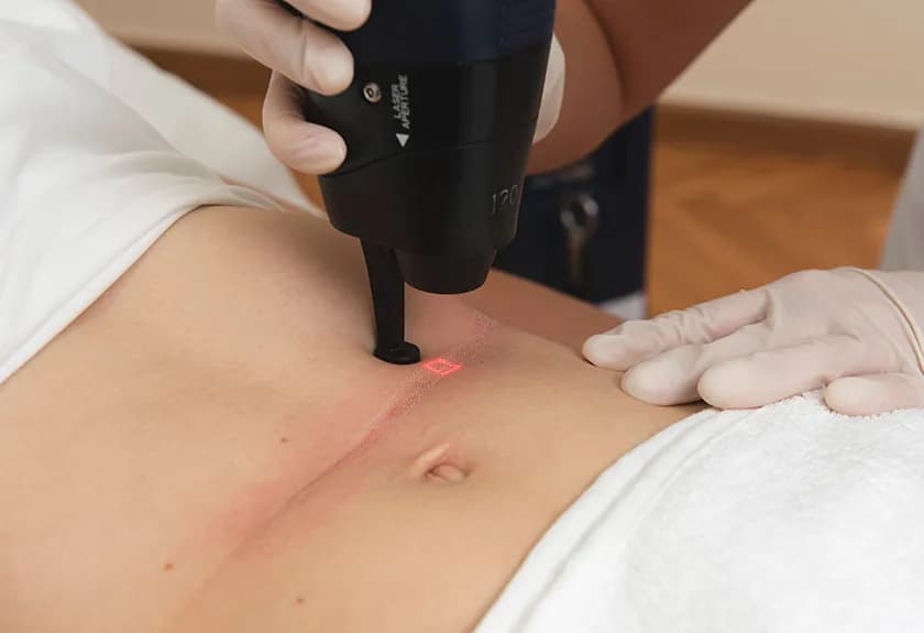 Jak się przygotować do laseru frakcyjnego, aby uniknąć problemów?