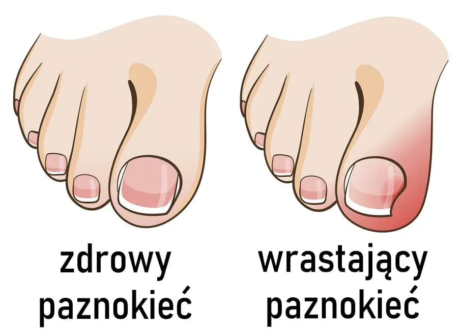 Czym obcinać paznokcie, aby uniknąć bólu i uszkodzeń?
