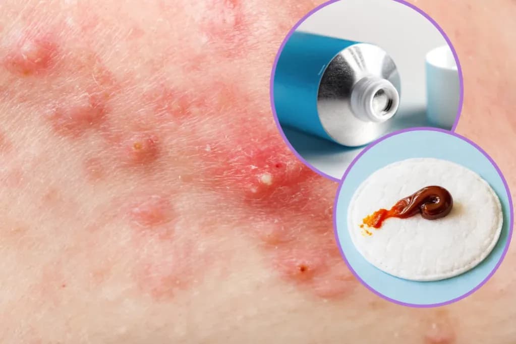 Ile trzymać maść ichtiolową na pryszczu, aby uniknąć bólu?