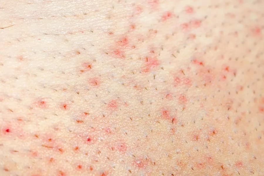 Jak leczyć zapalenie mieszka włosowego - skuteczne metody i porady