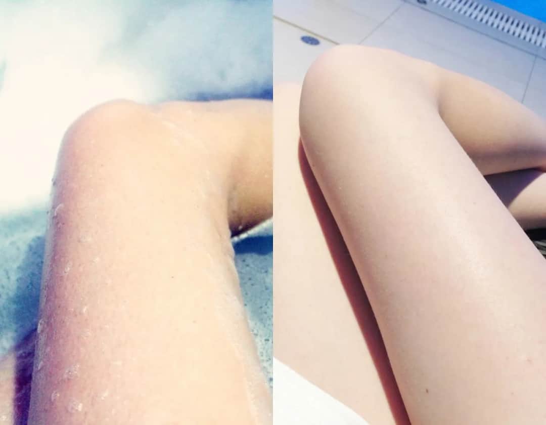 Jak pozbyć się krostek po goleniu - skuteczne metody na podrażnienia