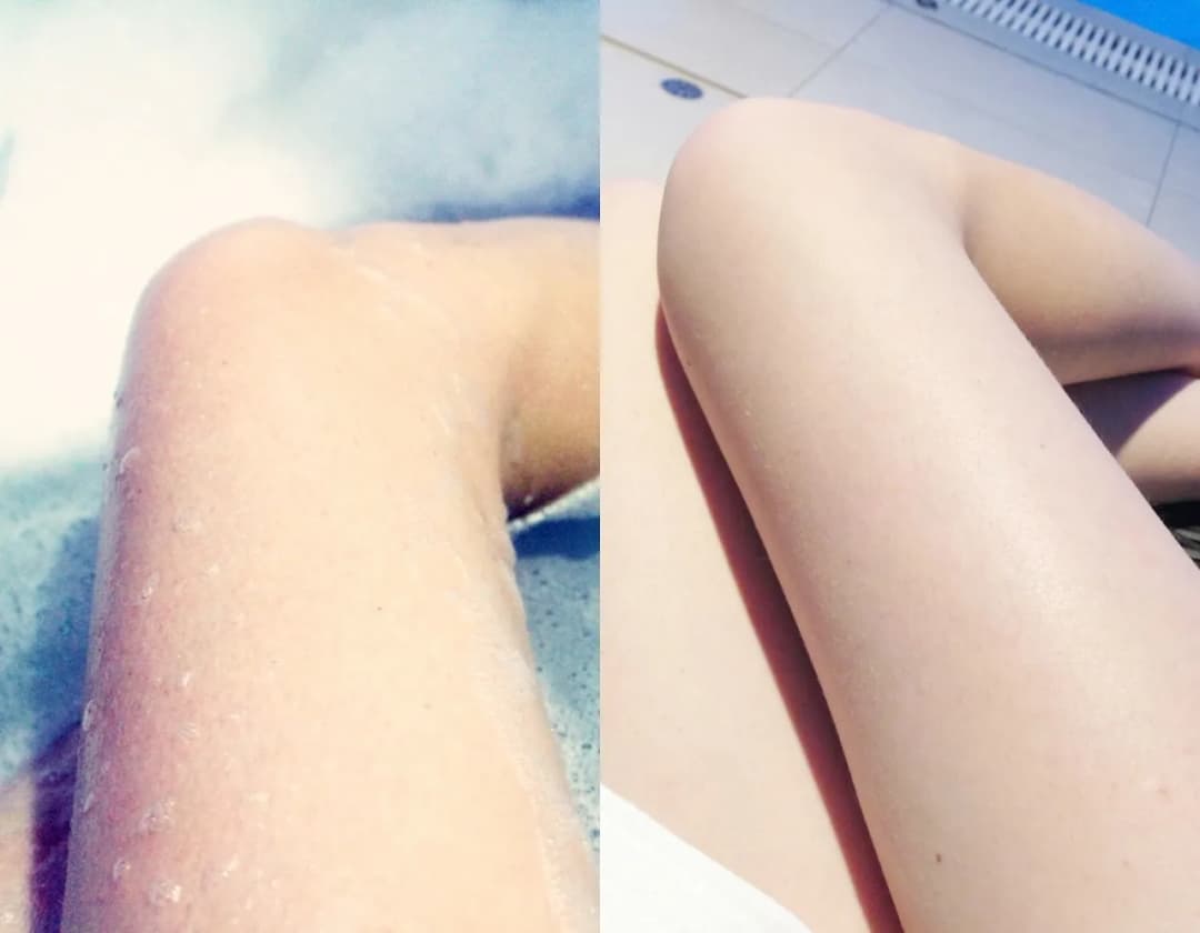 Jak pozbyć się krostek po goleniu - skuteczne metody na podrażnienia