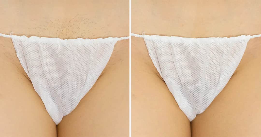 Bikini głębokie co to? Poznaj metody depilacji i efekty