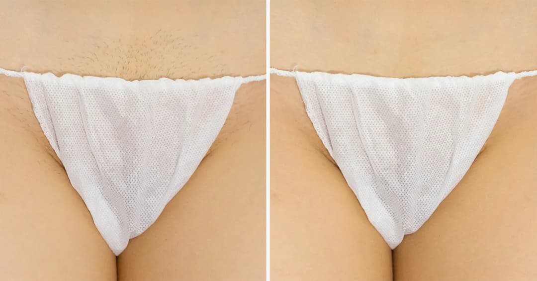 Bikini głębokie co to? Poznaj metody depilacji i efekty