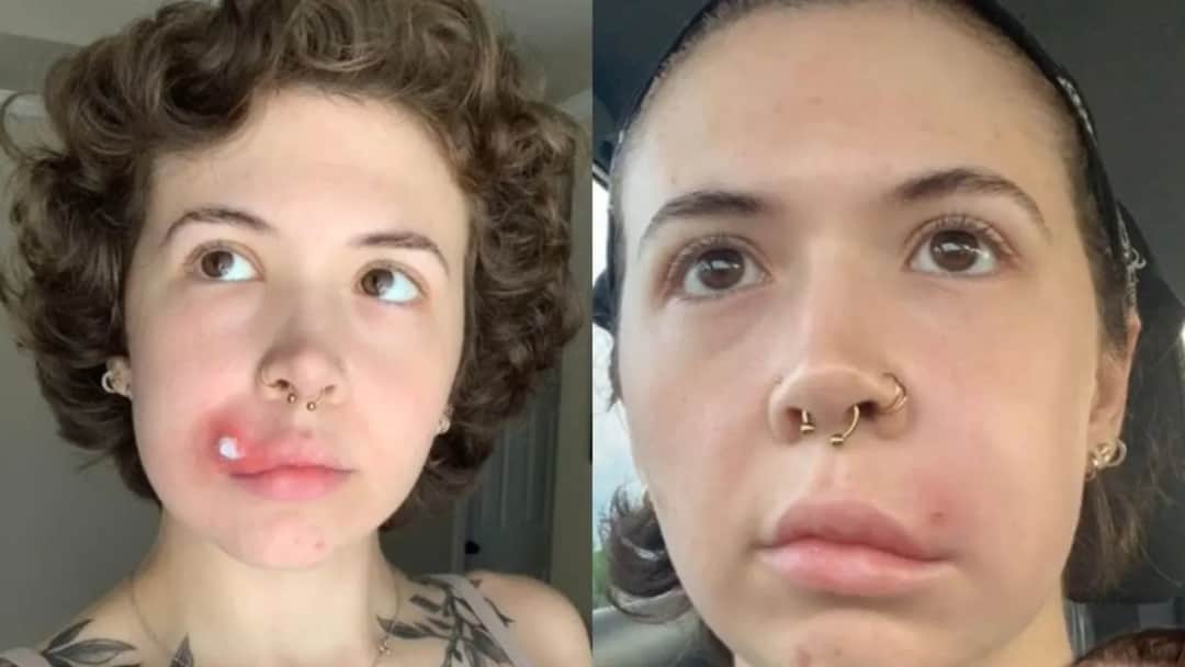 Co zrobić po wyciśnięciu pryszcza, aby uniknąć infekcji i blizn?