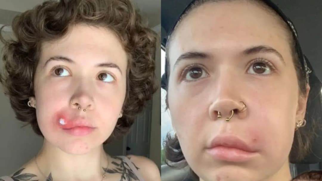 Co zrobić po wyciśnięciu pryszcza, aby uniknąć infekcji i blizn?