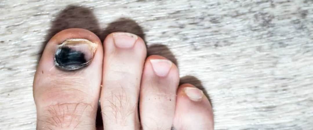 Jak leczyć czarny paznokieć: skuteczne metody na ból i dyskomfort