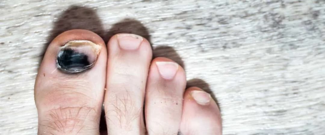 Jak leczyć czarny paznokieć: skuteczne metody na ból i dyskomfort