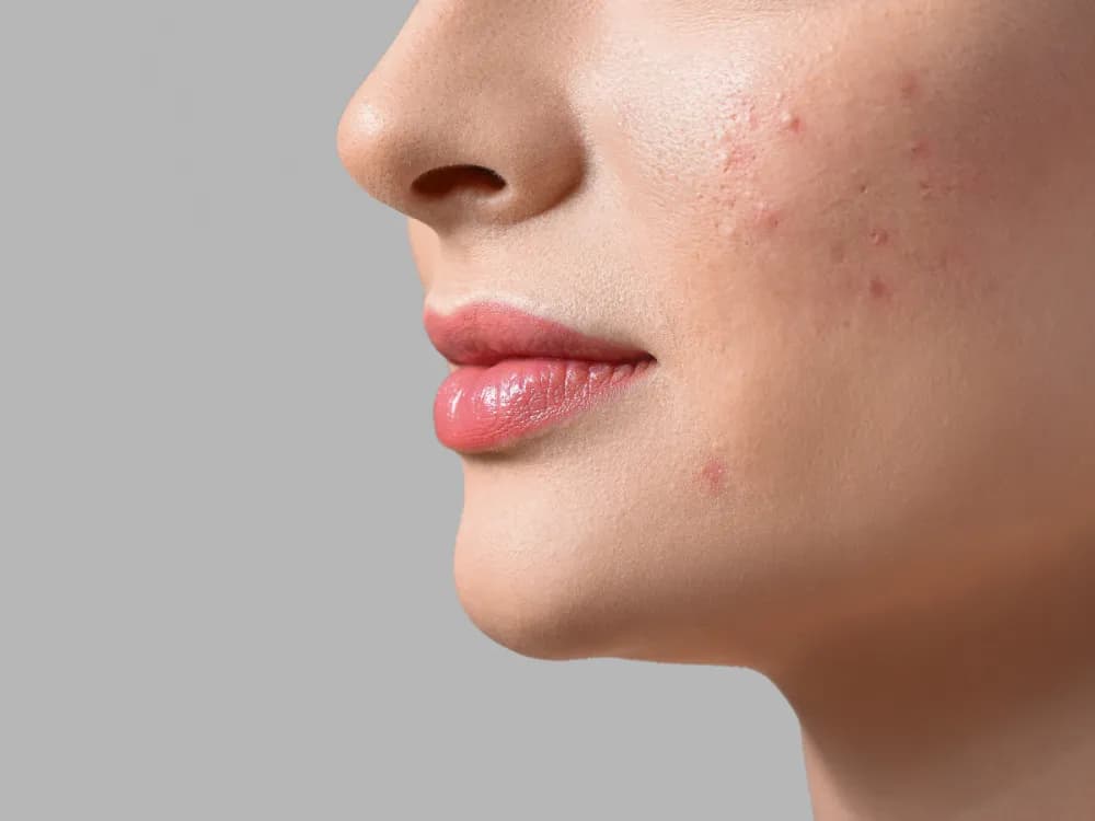 Dlaczego wyskakują pryszcze na twarzy? Poznaj przyczyny i rozwiązania