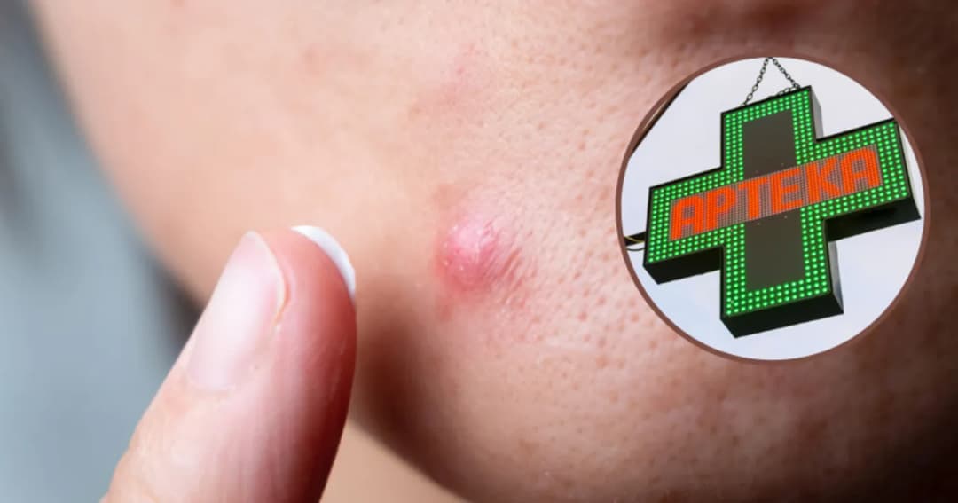 Skuteczne maści na pryszcze: uniknij bólu i podrażnień skóry