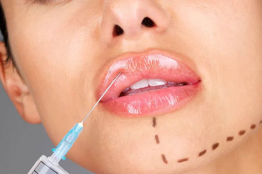 Czy powiększanie ust jest bezpieczne? Poznaj ryzyka i skutki uboczne