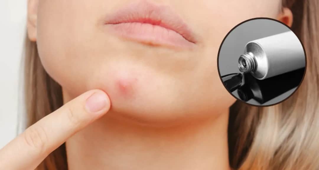 Jak pozbyć się pryszcza który jeszcze nie wyszedł i uniknąć blizn