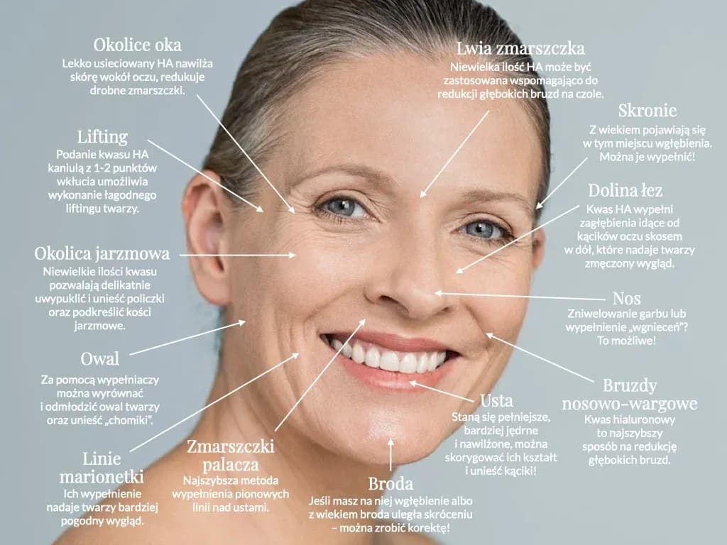 Jak głęboko wstrzykuje się kwas hialuronowy? Poznaj kluczowe informacje