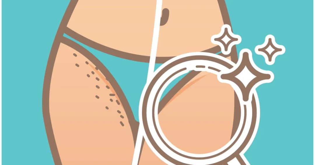 Czym golić miejsca intymne, aby uniknąć podrażnień i bólu?