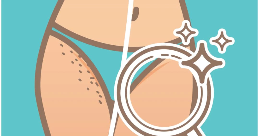 Czym golić miejsca intymne, aby uniknąć podrażnień i bólu?