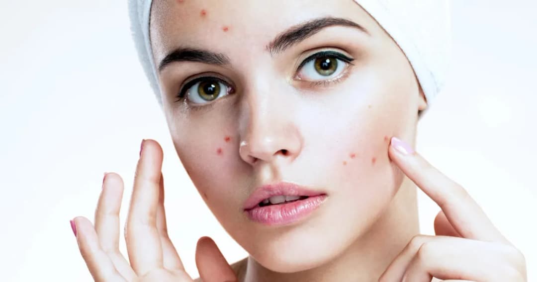 Czy wyciskać pryszcze? Poznaj ryzyka i bezpieczne alternatywy