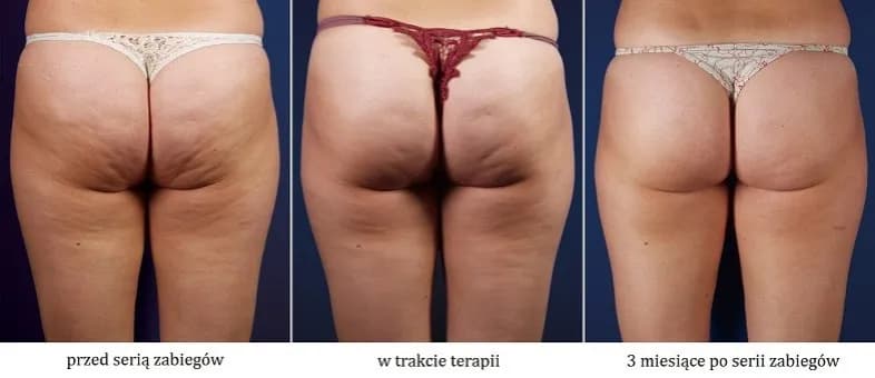 Jakie zioła na cellulit skutecznie redukują widoczność pomarańczowej skórki