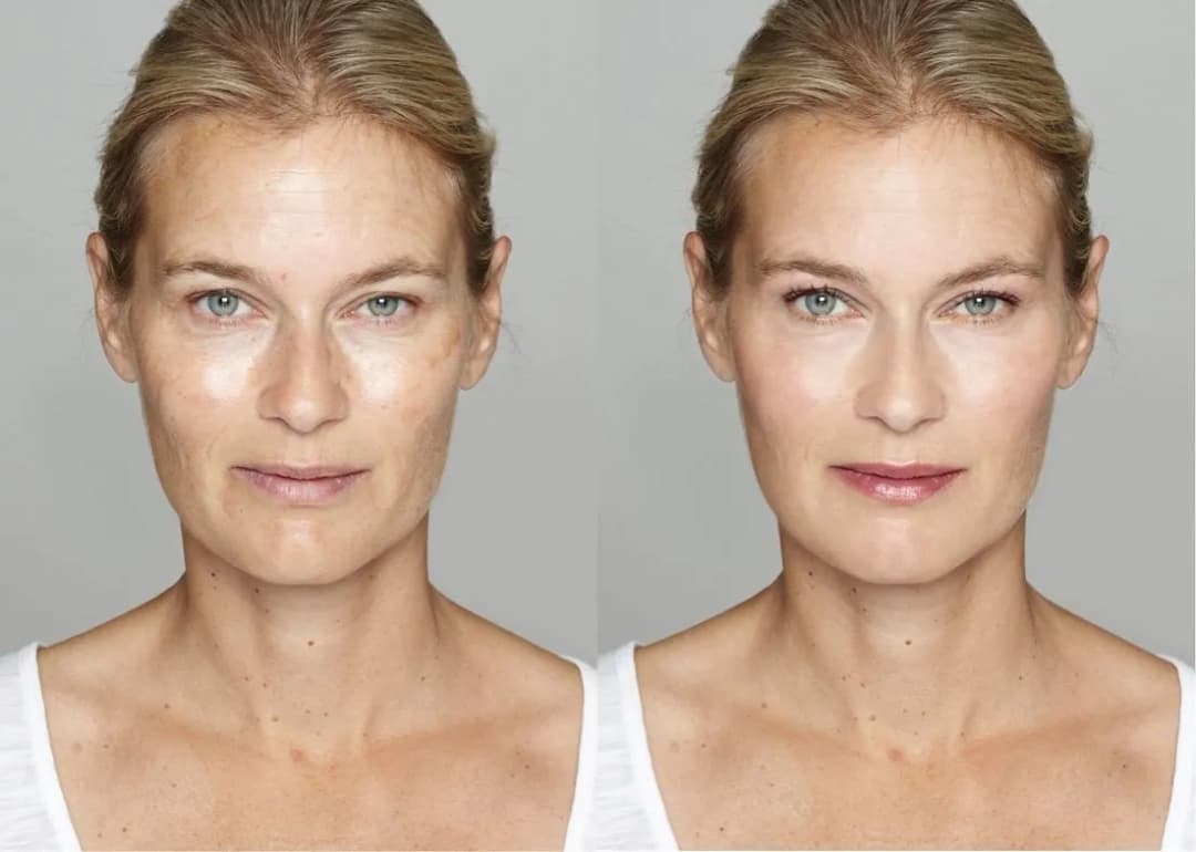 Ile kosztuje botox na czoło? Ceny w Polsce i co warto wiedzieć