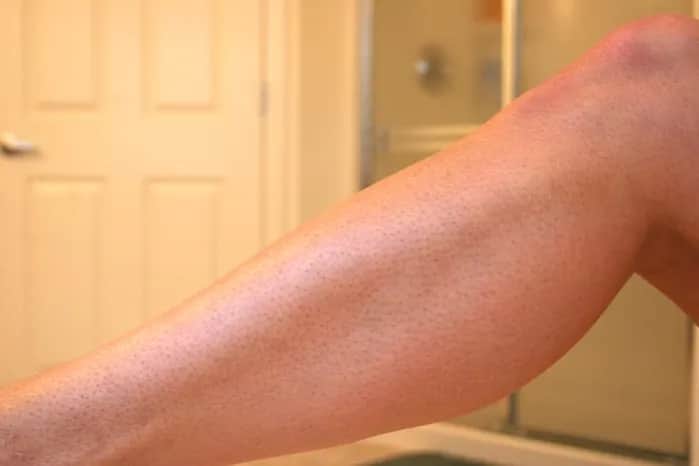 Co na truskawkowe nogi: skuteczne metody na gładką skórę