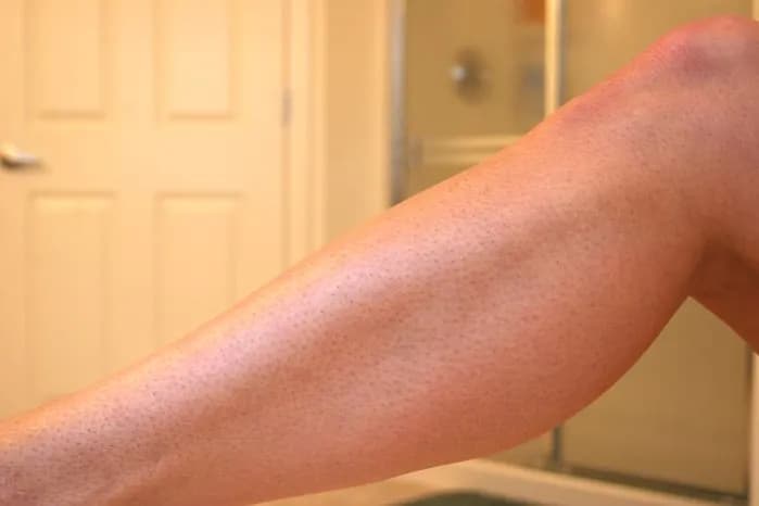 Co na truskawkowe nogi: skuteczne metody na gładką skórę