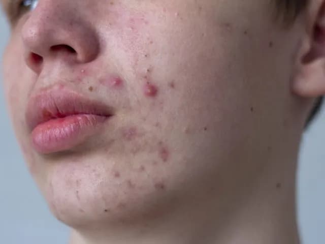 Co oznaczają pryszcze na brodzie? Poznaj przyczyny i rozwiązania