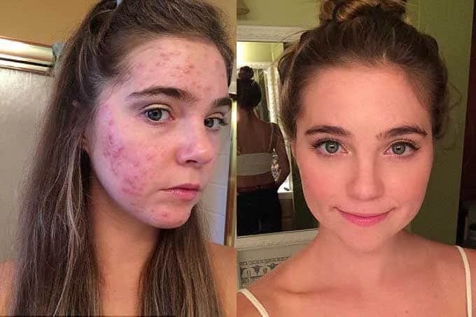 Czy pryszcz sam zniknie? Oto prawda o naturalnym gojeniu Czy pryszcz sam zniknie? Oto prawda o naturalnym gojeniu